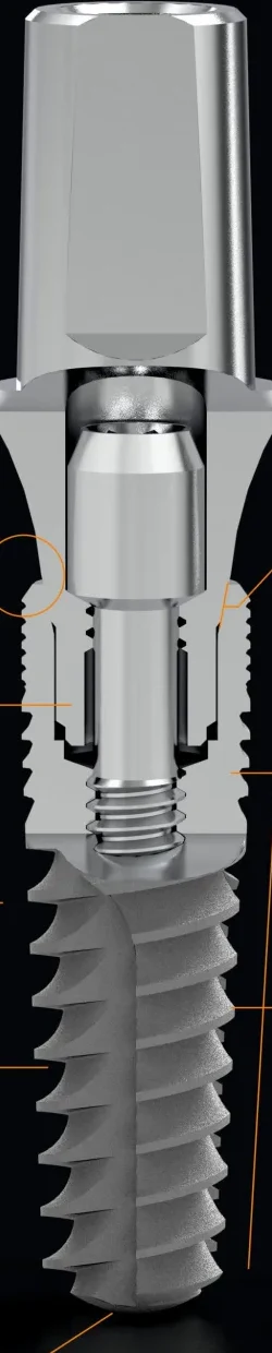 Venüs — Implant systems